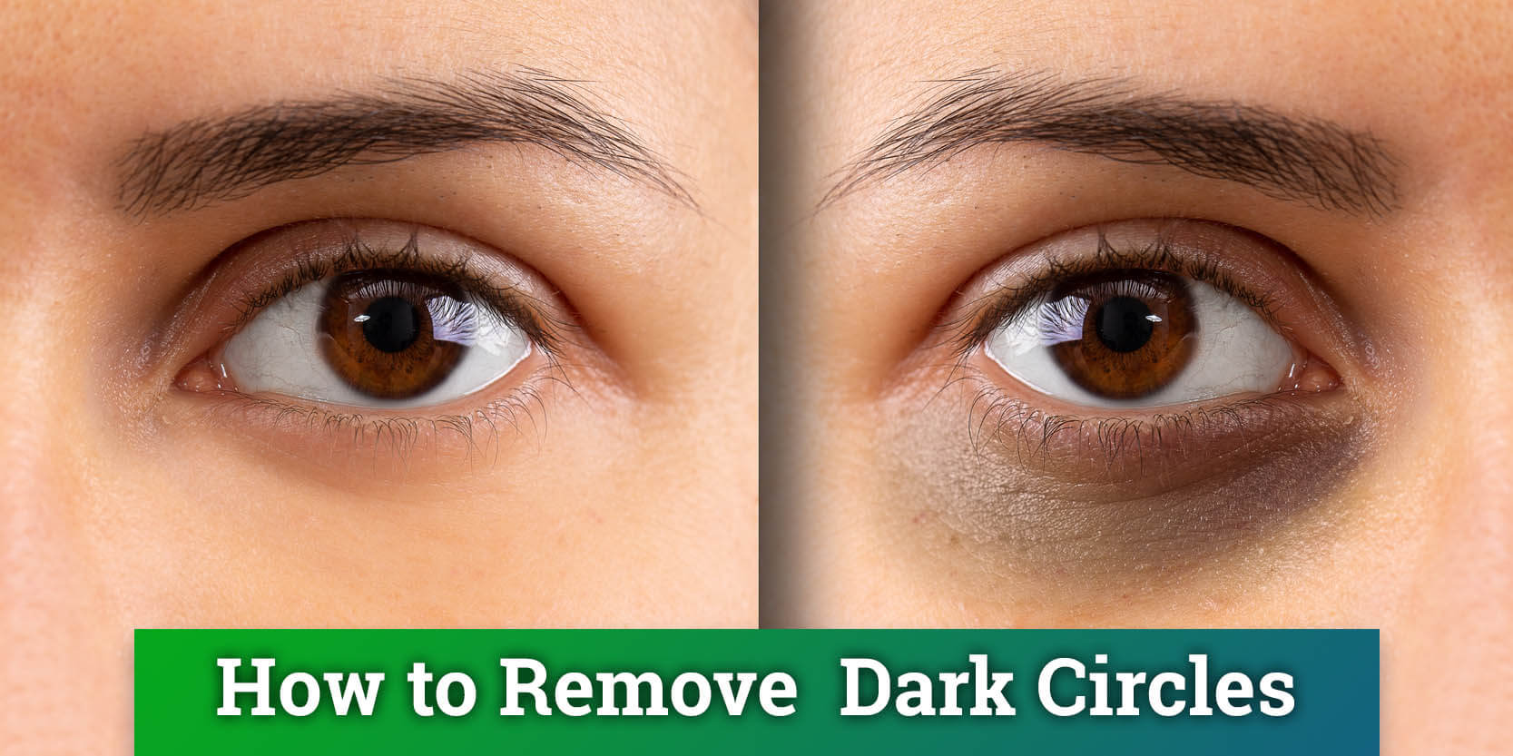 Reducing under-eye circles